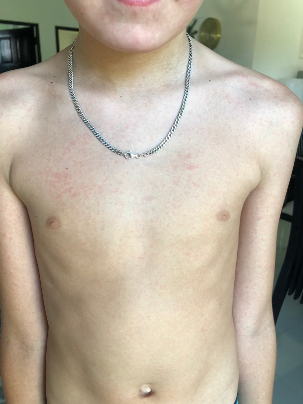 Chikungunya virus ger röda prickar och rodnader över hela kroppen.