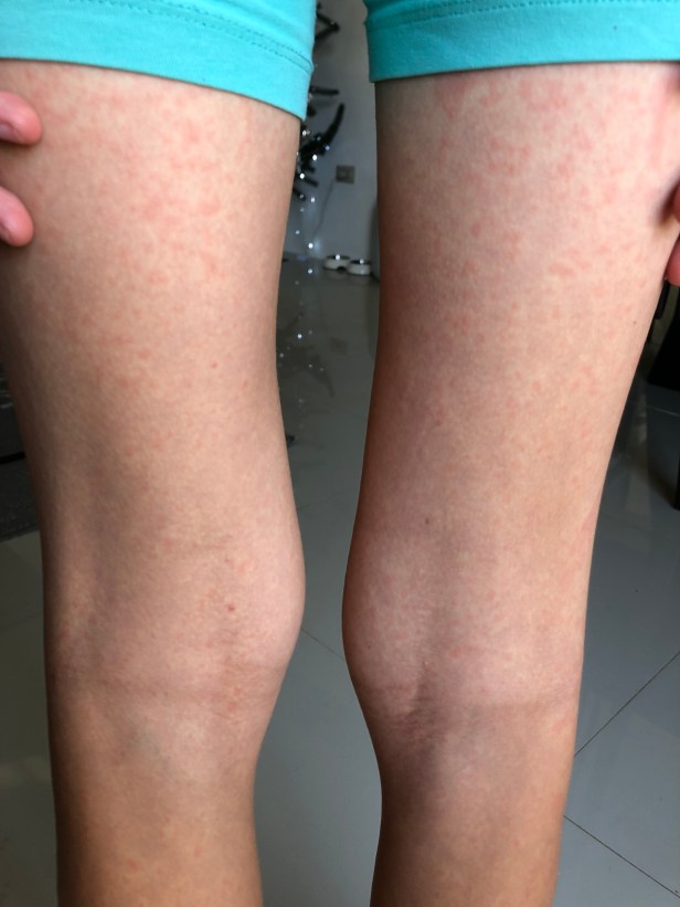 Chikungunya virus kommer från myggors bett.